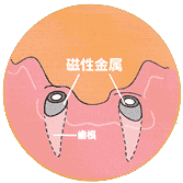 歯根の治療