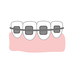 歯の矯正