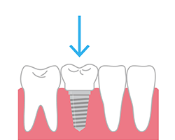 インプラント