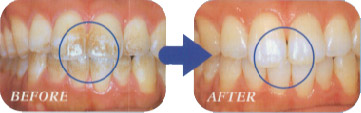 歯の表面の汚れをとり研磨をします。また、歯の表面へのカルシウム補給を助け、汚れをつきにくくします。