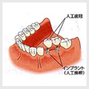 インプラント