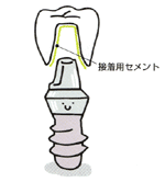 インプラント固定