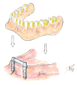 歯科用のインプラント二回法