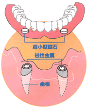 磁石式の入れ歯
