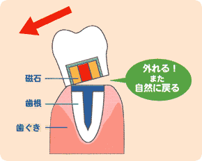 機械的に固定