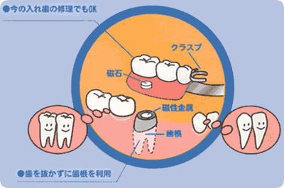 磁石式入れ歯による治療法