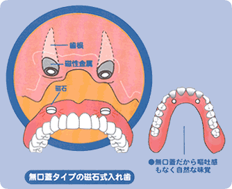 磁石式入れ歯による治療法