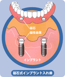 磁石式入れ歯による治療法