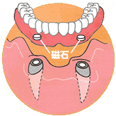 入れ歯の製作