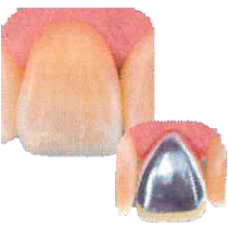 硬質レジン