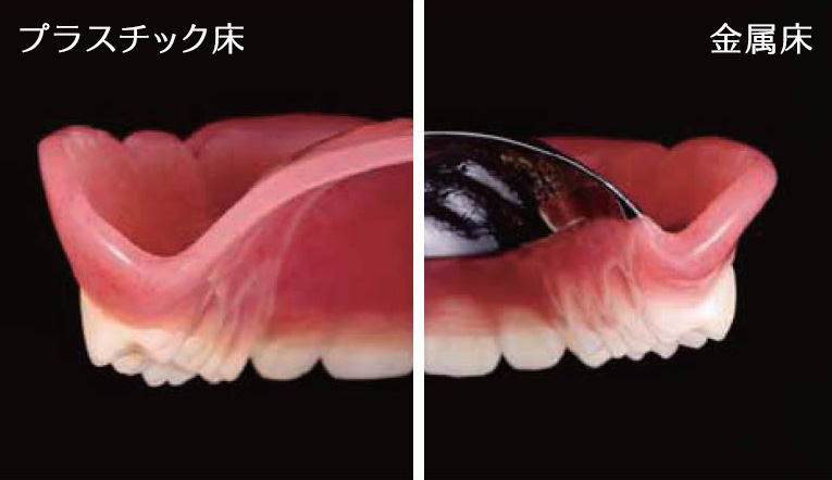 プラスチック床義歯（左）・金属床（右）についての画像
