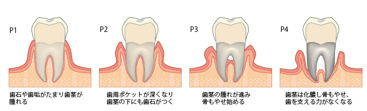 歯周病の進行についての画像